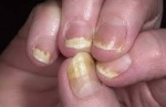 Болести на ноктите