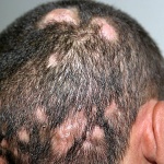 Гъбични инфекции на кожата,ноктите и косата
